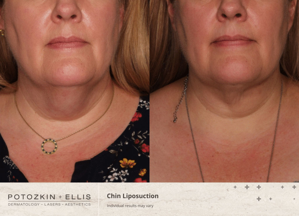 Liposuction before and after from Potozkin + Ellis