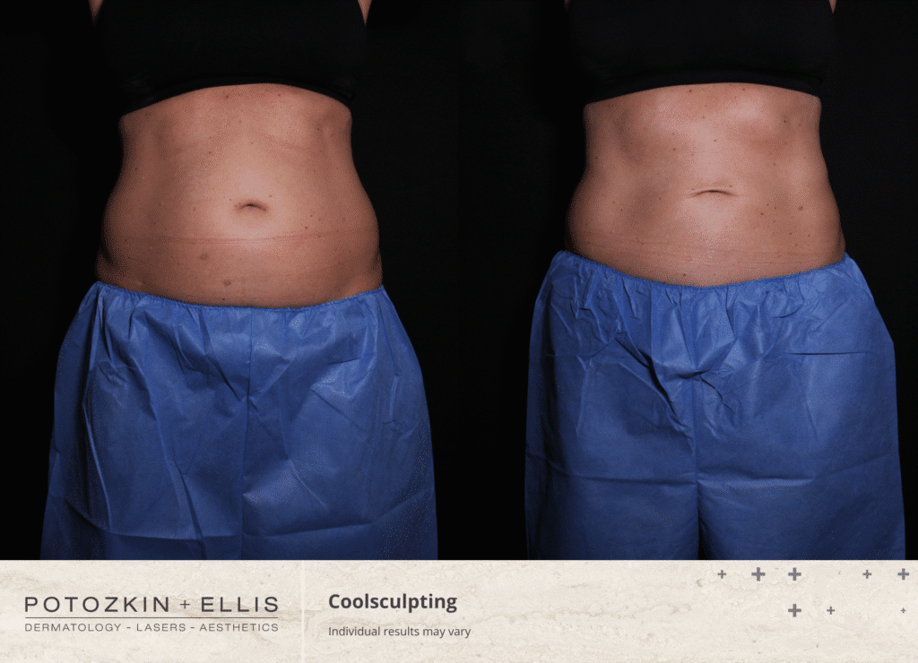 Coolsculpting before and after from Potozkin + Ellis