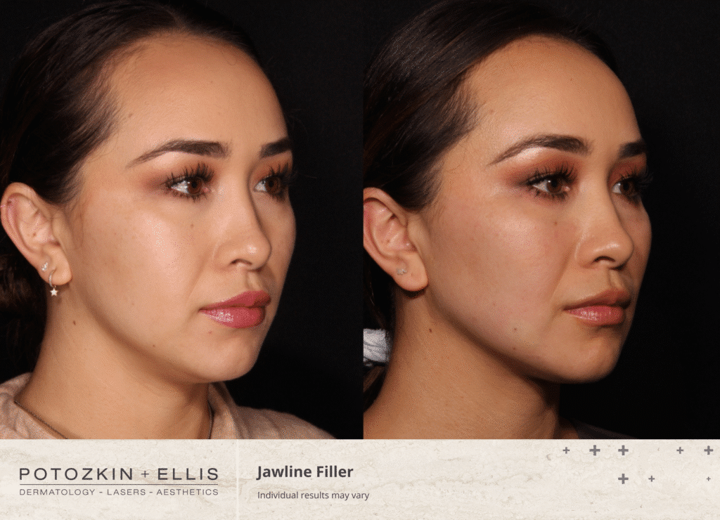 Jawline Filler before and after from Potozkin + Ellis