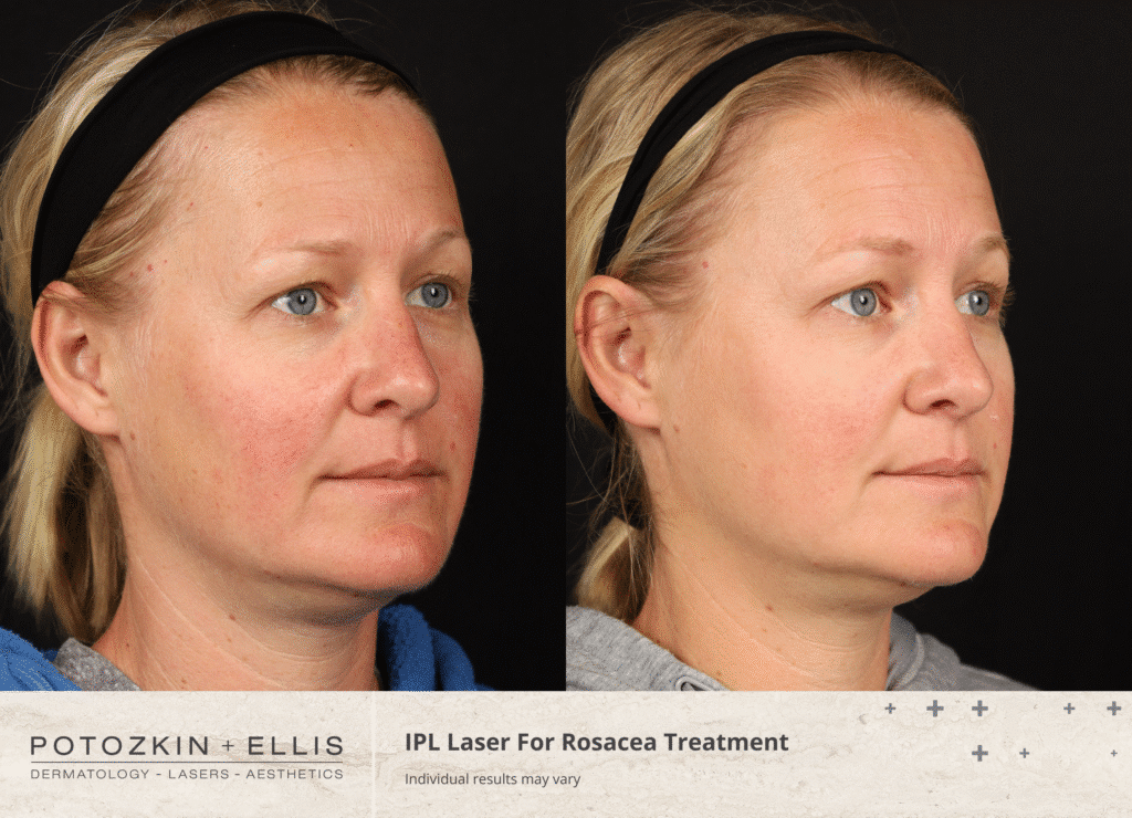 Rosacea before and after from Potozkin + Ellis