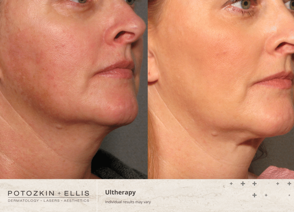 Ultherapy before and after from Potozkin + Ellis