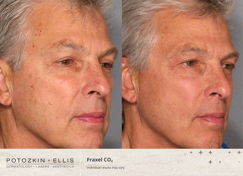 CO2 Fraxel Before and After Photos of a middle-aged Male