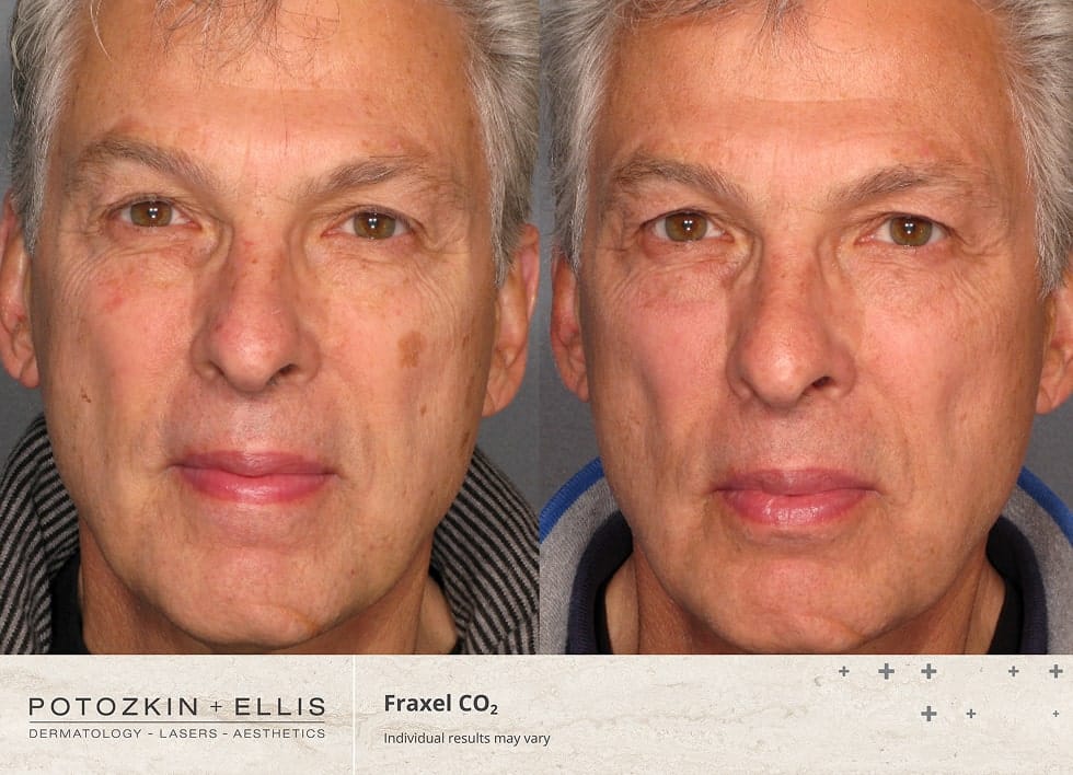 CO2 Fraxel Before and After Photos of a middle-aged Male