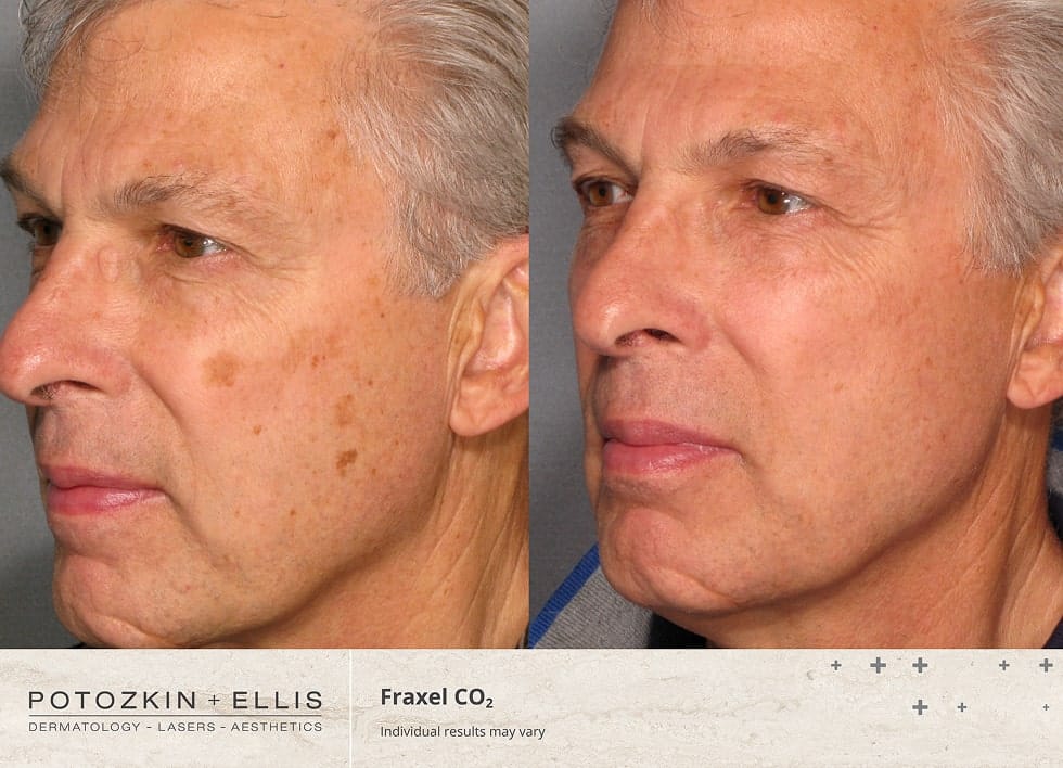 CO2 Fraxel Before and After Photos of a middle-aged Male