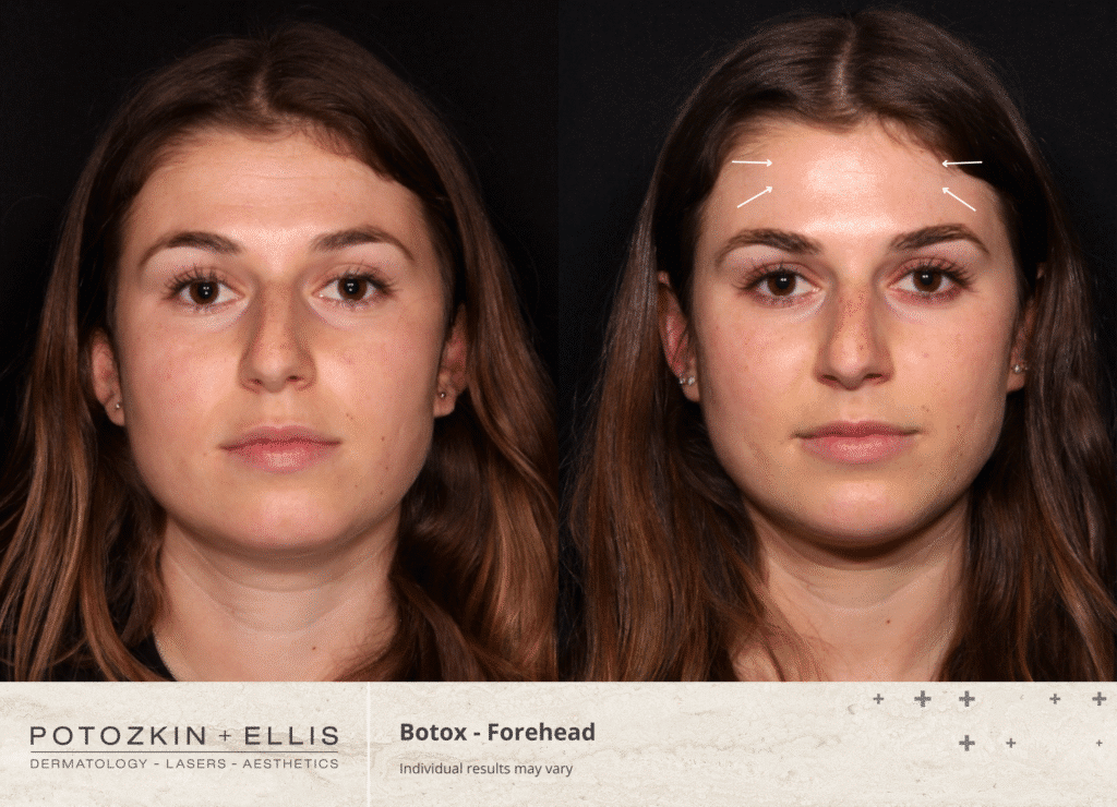 before and after botox forehead
