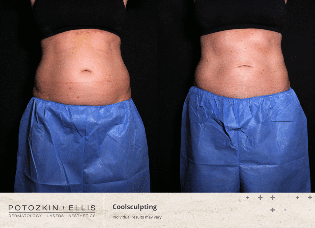 Coolsculpting before and after results