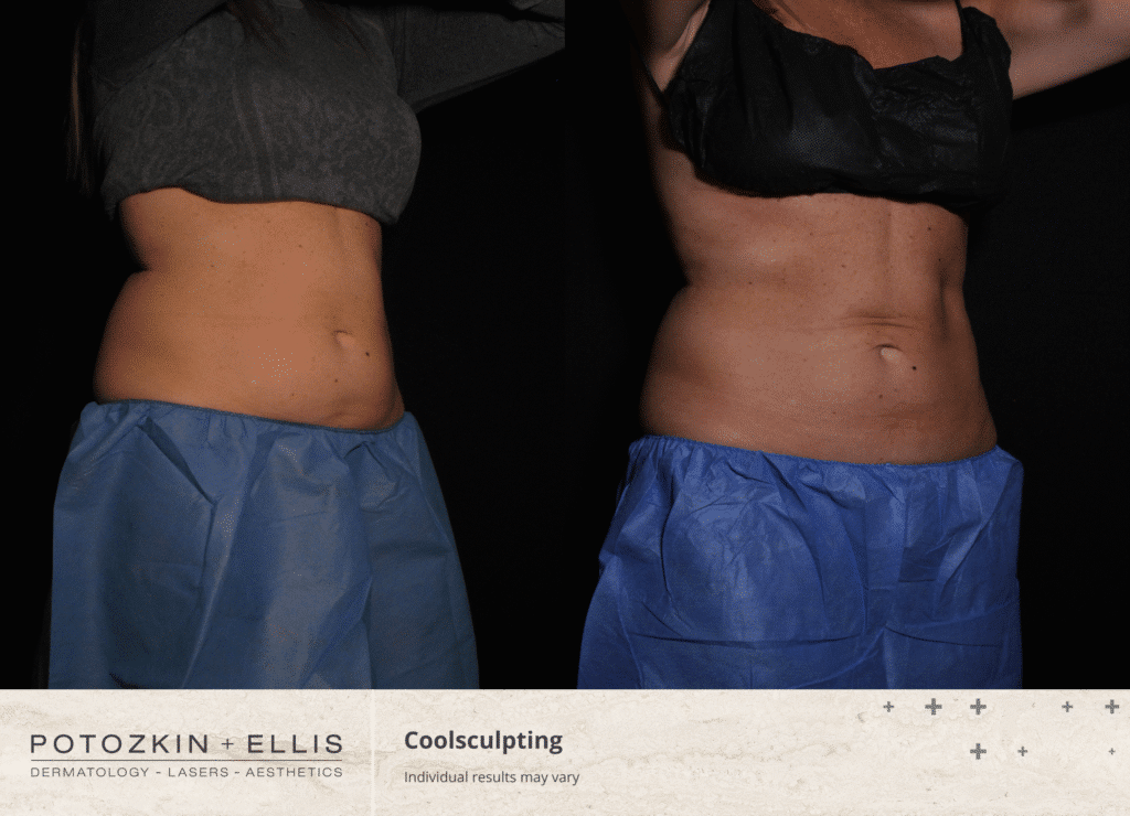 Coolsculpting before and after results