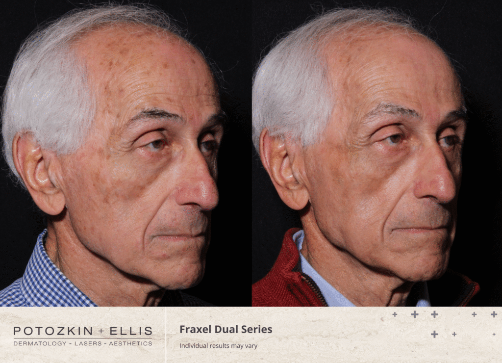 sunspots and age spots before and after
