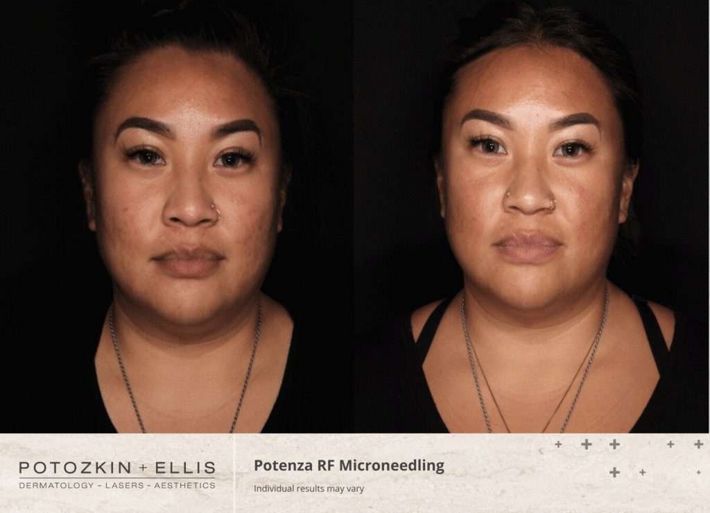 RF Microneedling before and after photos of a female patient at Potozkin and Ellis Dermatology