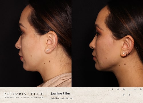 Before and after image of Potozkin and Ellis dermatology patient