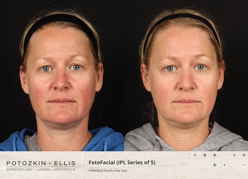 Before and after image of Potozkin and Ellis dermatology patient
