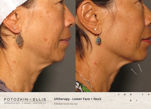 Before and after image of Potozkin and Ellis dermatology patient
