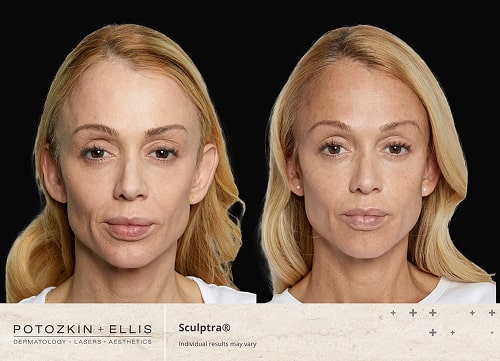 Before and after image of Potozkin and Ellis dermatology patient