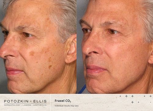 Before and after image of Potozkin and Ellis dermatology patient