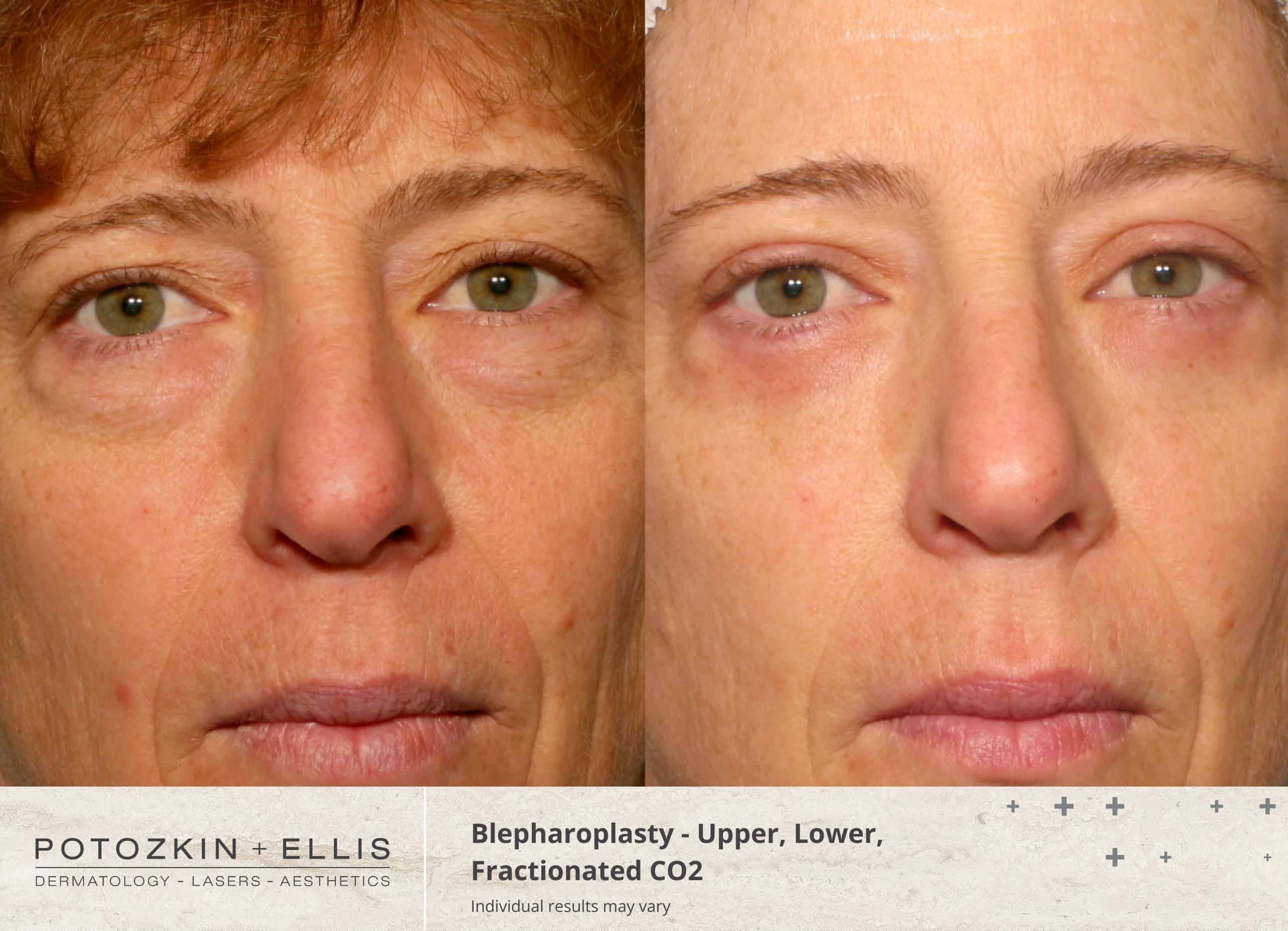 Blepharoplasty Before and After photos at Potozkin and Ellis Dermatology