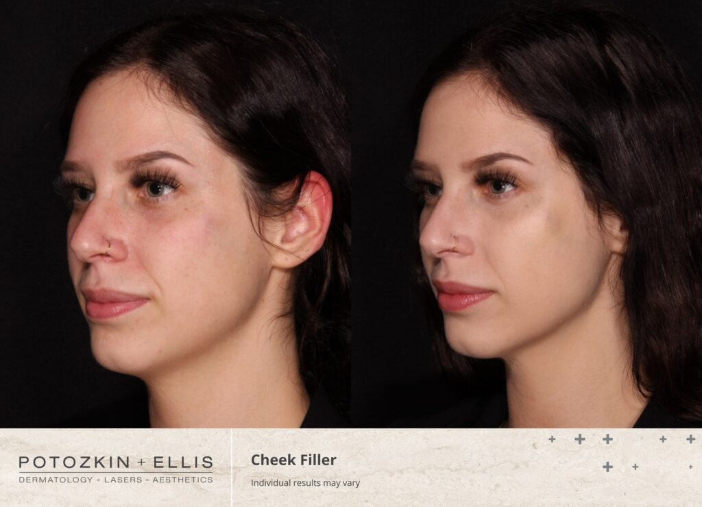 Cheek Filler Before and After photos at Potozkin and Ellis Dermatology