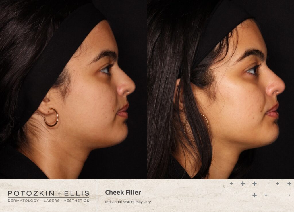 Cheek Filler Before and After photos at Potozkin and Ellis Dermatology