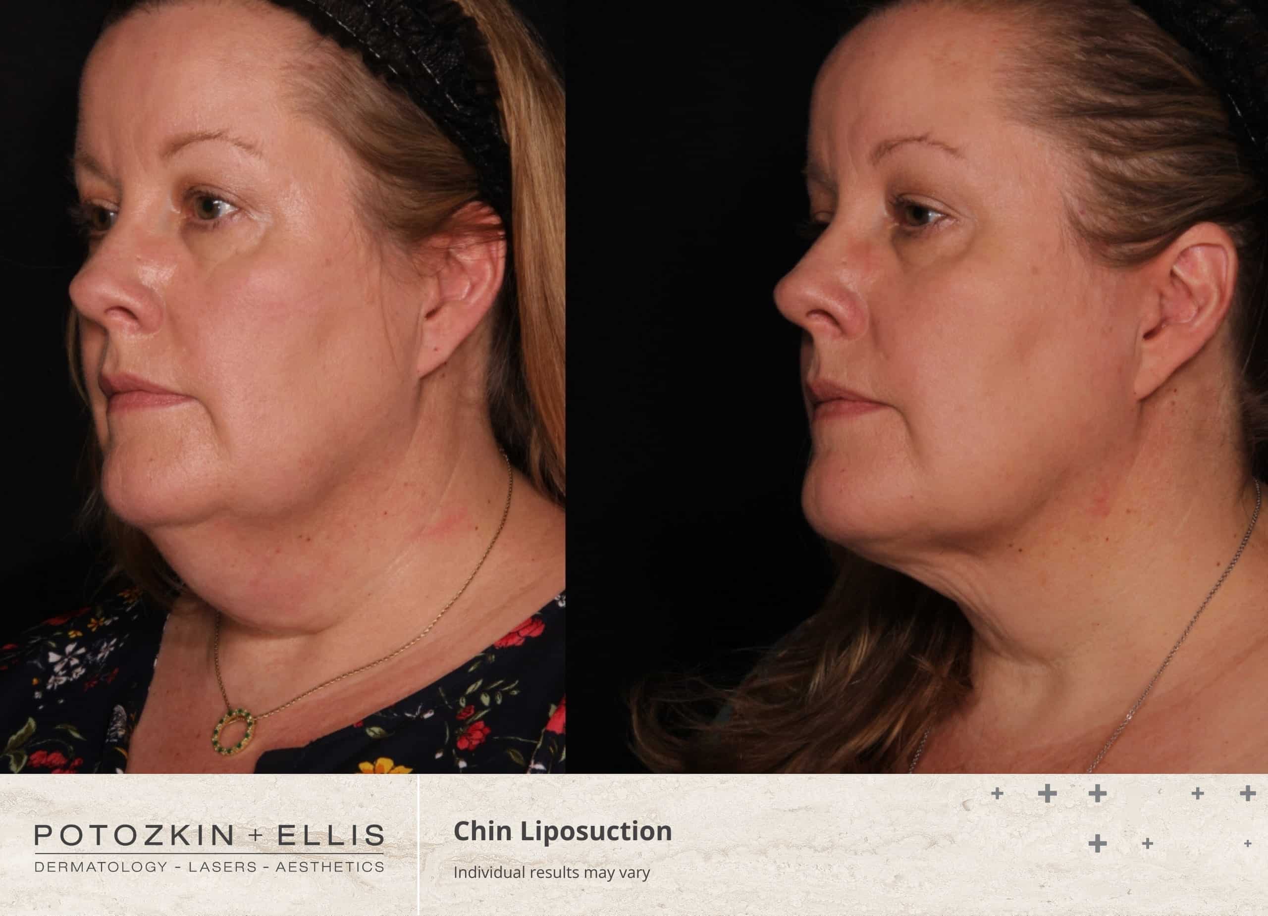 Chin Liposuction Before and After photos at Potozkin and Ellis Dermatology