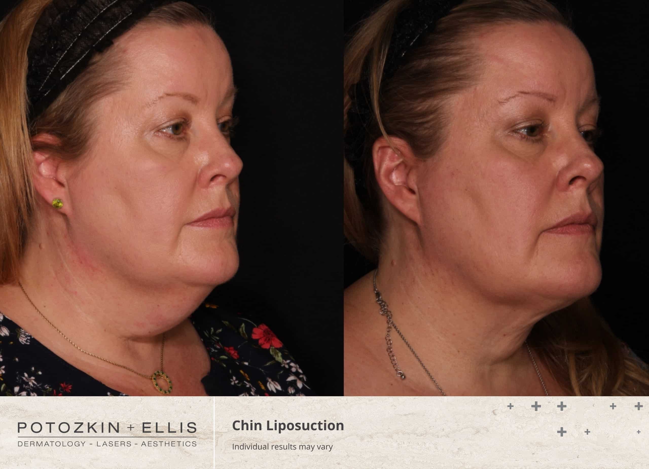 Chin Liposuction Before and After photos at Potozkin and Ellis Dermatology