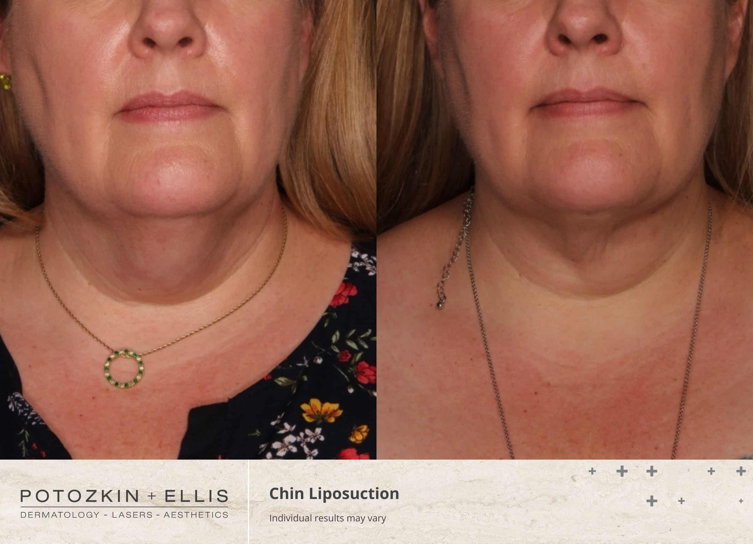 Chin Liposuction Before and After photos at Potozkin and Ellis Dermatology