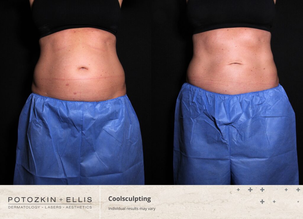 CoolSculpting Before and After photos at Potozkin and Ellis Dermatology