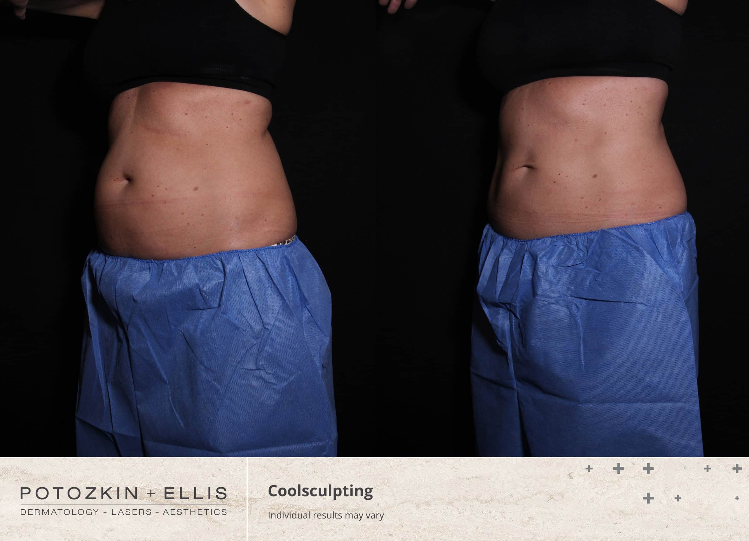 CoolSculpting Before and After photos at Potozkin and Ellis Dermatology