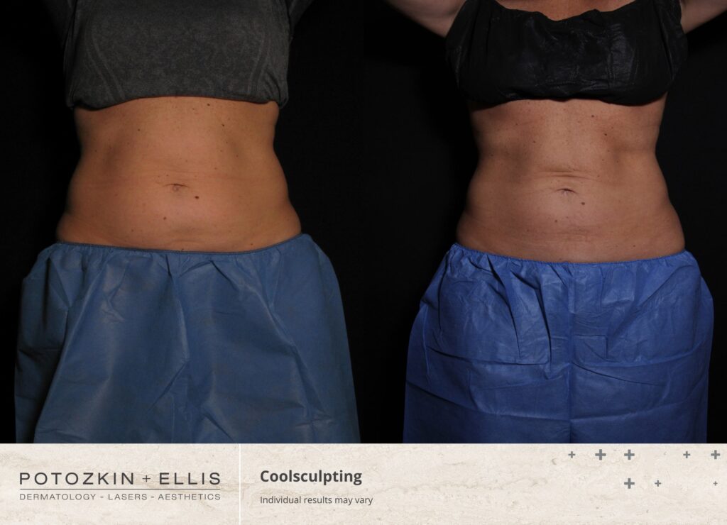 CoolSculpting Before and After photos at Potozkin and Ellis Dermatology