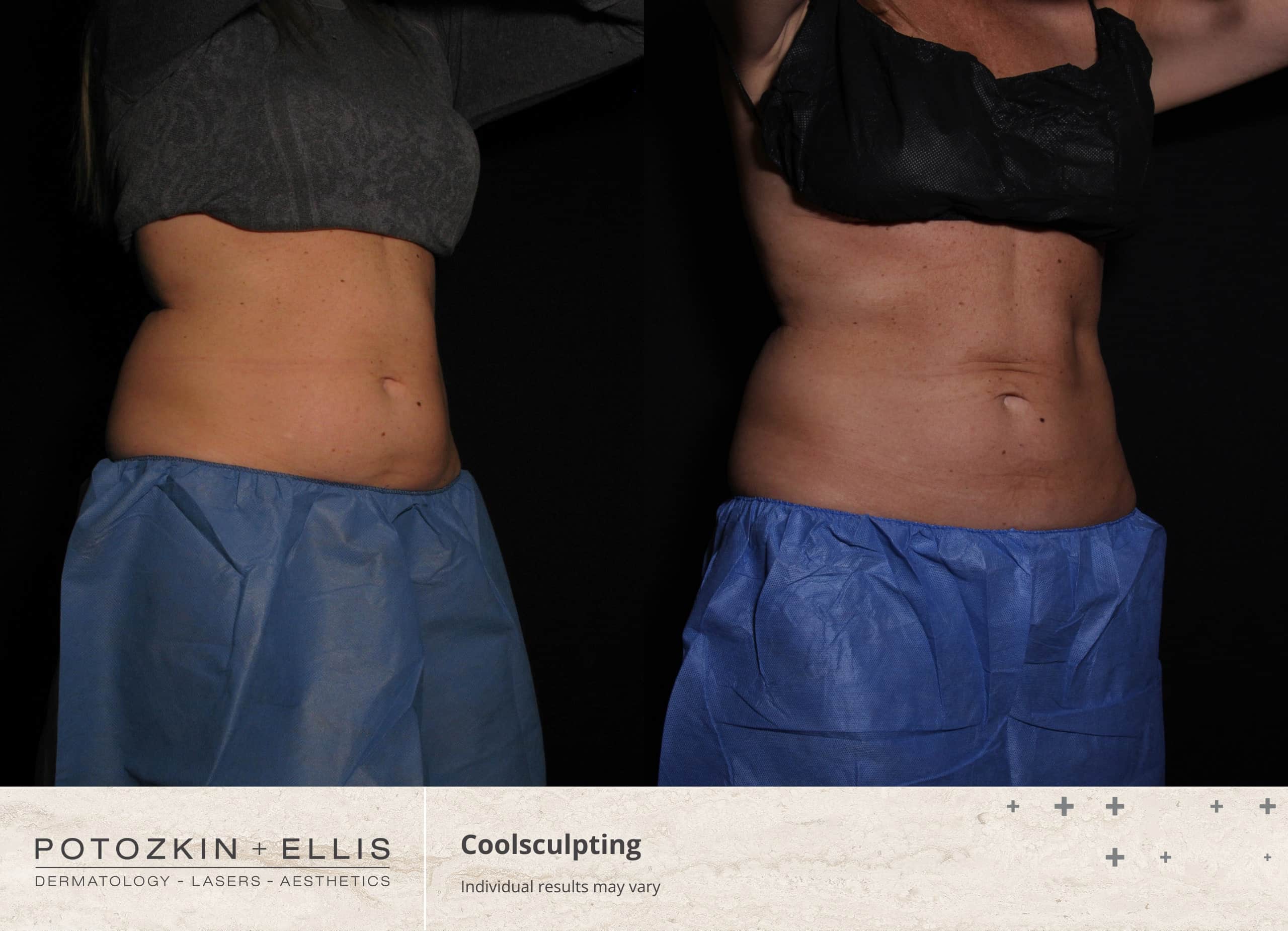 CoolSculpting Before and After photos at Potozkin and Ellis Dermatology