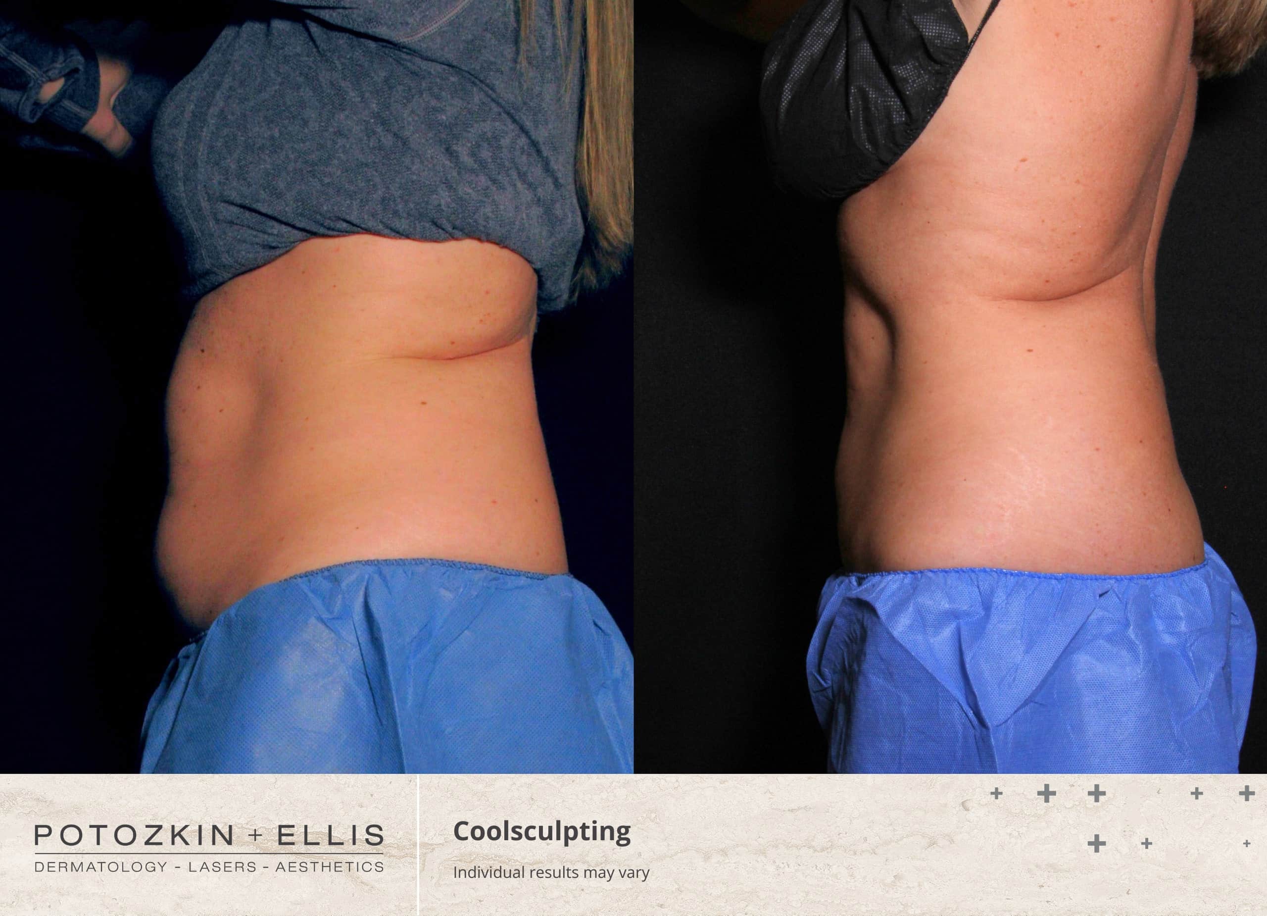 CoolSculpting Before and After photos at Potozkin and Ellis Dermatology