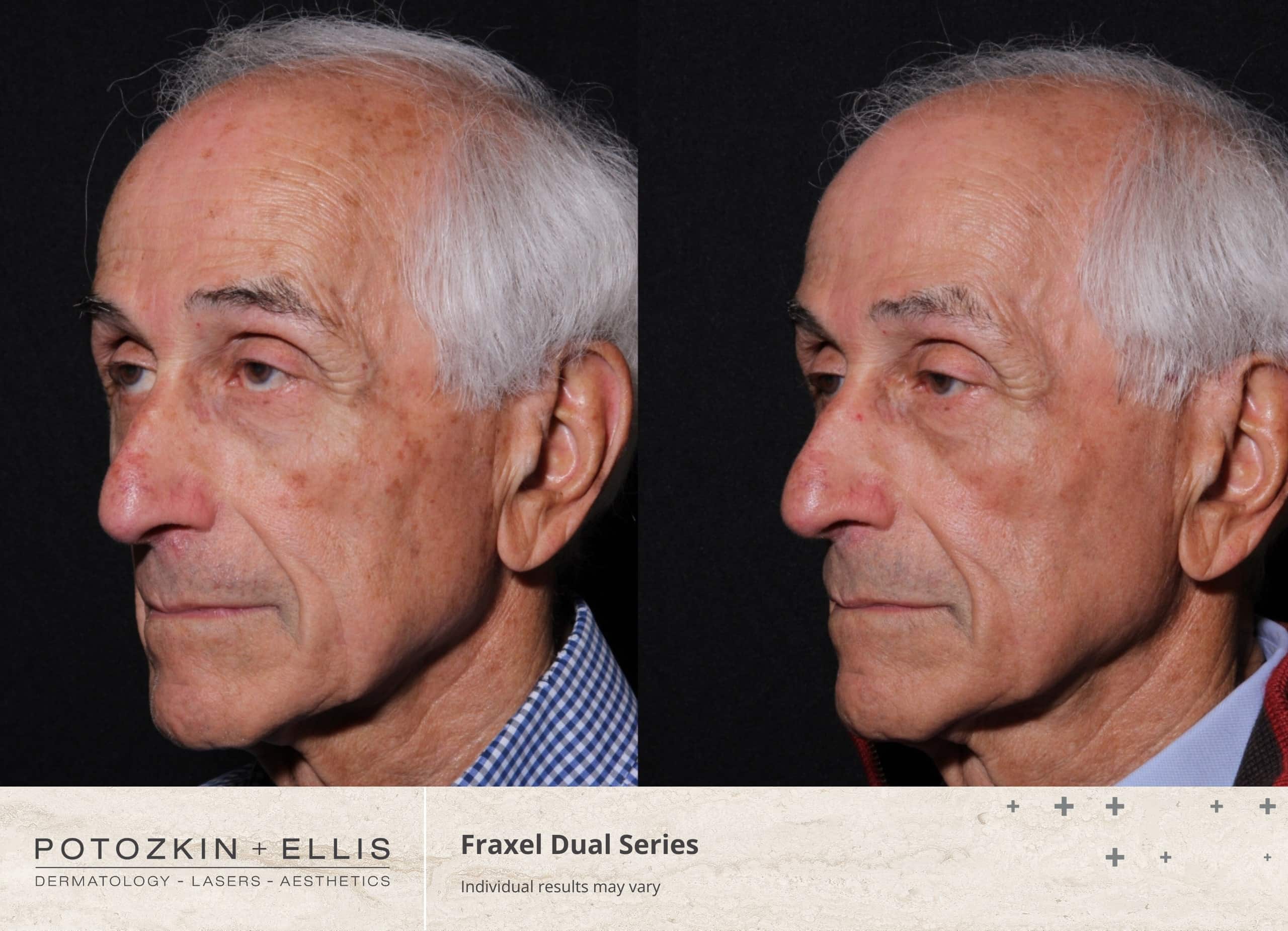 Fraxel Before and After photos at Potozkin and Ellis Dermatology