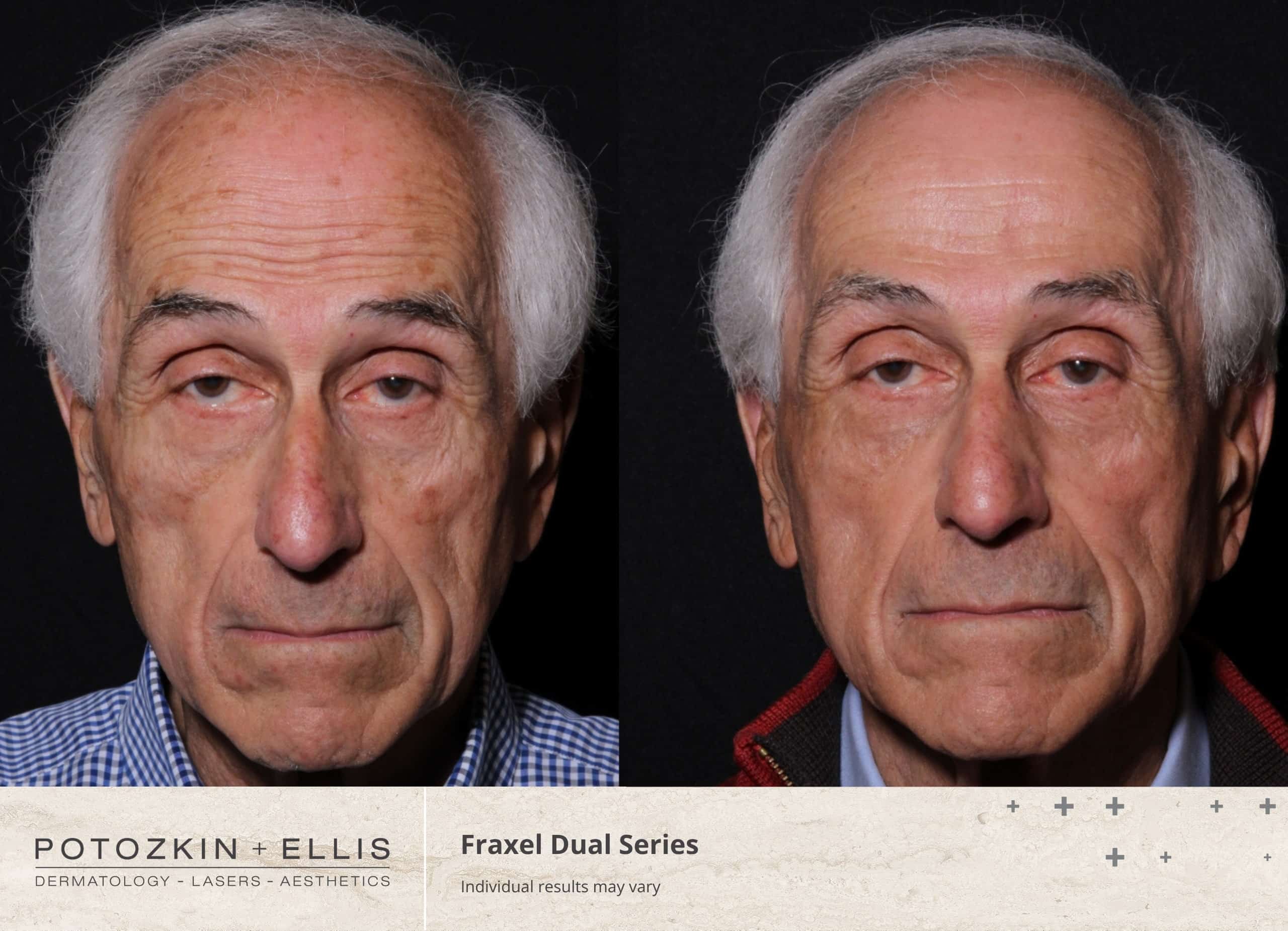 Fraxel Before and After photos at Potozkin and Ellis Dermatology