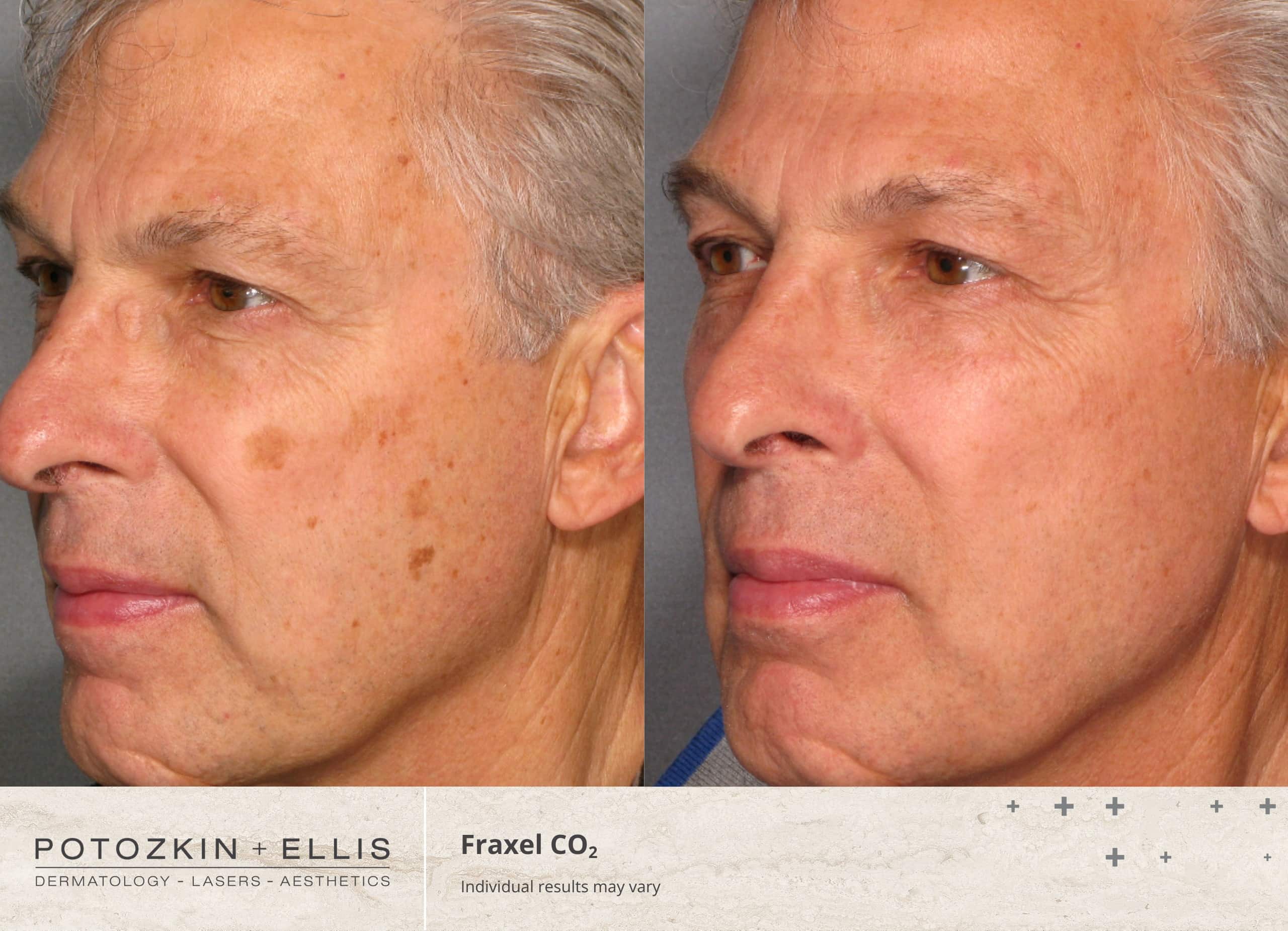 Fraxel CO2 Before and After photos at Potozkin and Ellis Dermatology