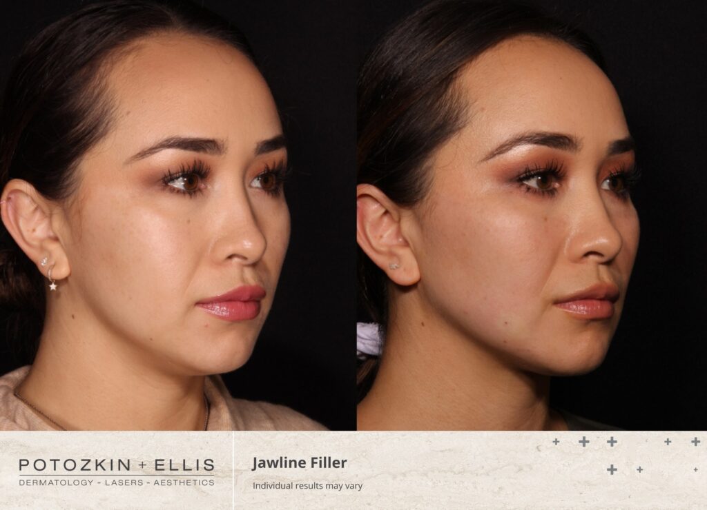 Jawline Filler Before and After photos at Potozkin and Ellis Dermatology