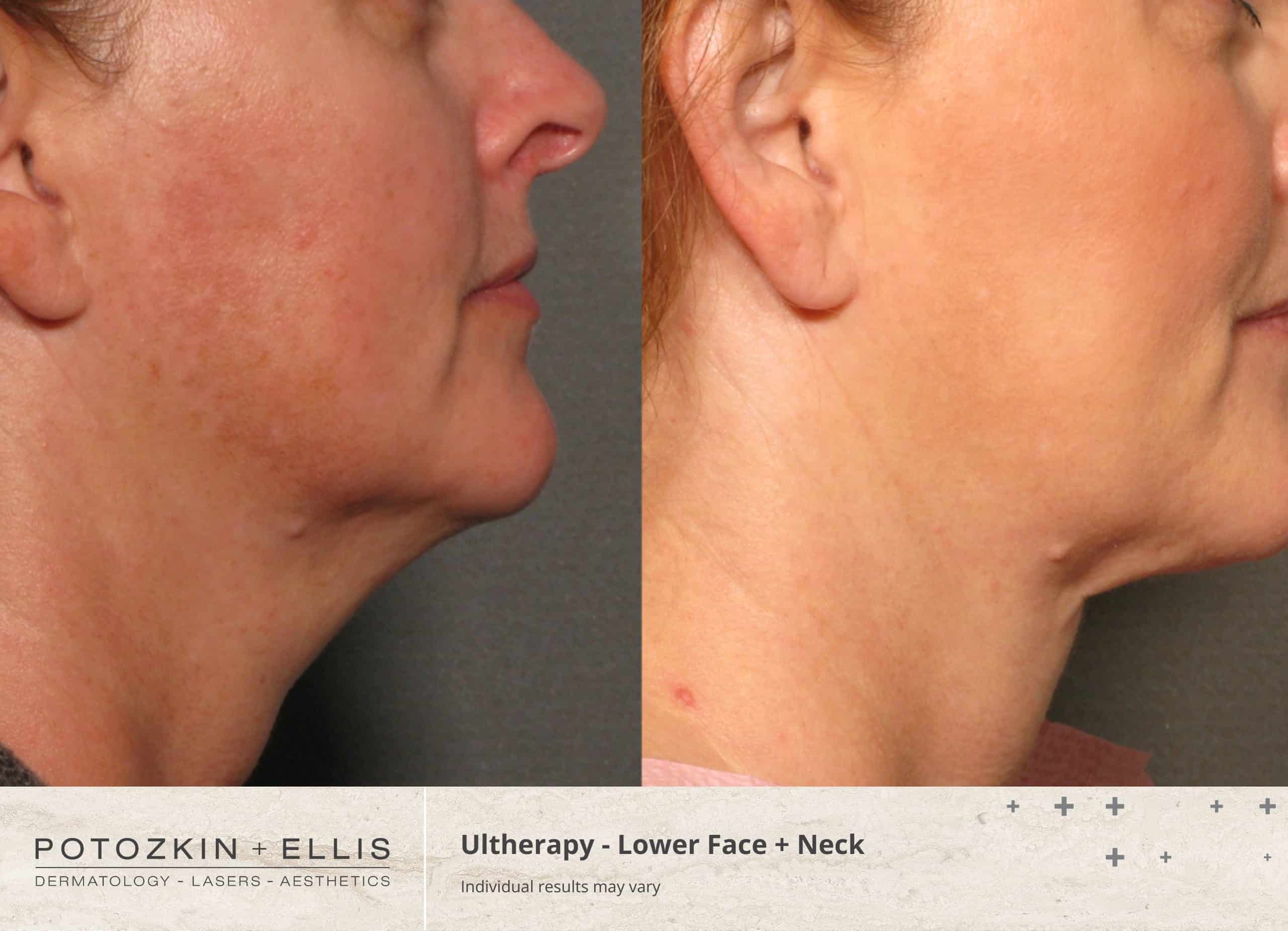 Ultherapy Before and After photos at Potozkin and Ellis Dermatology