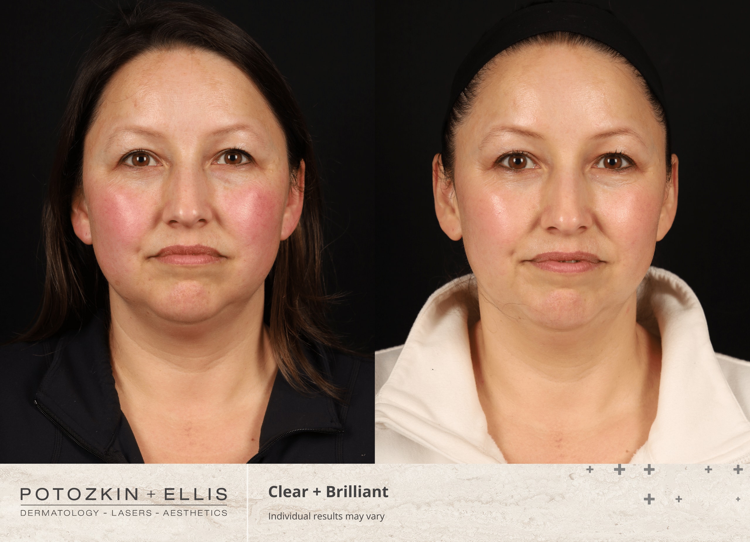 Potozkin + Ellis | Clear + Brilliant treatment