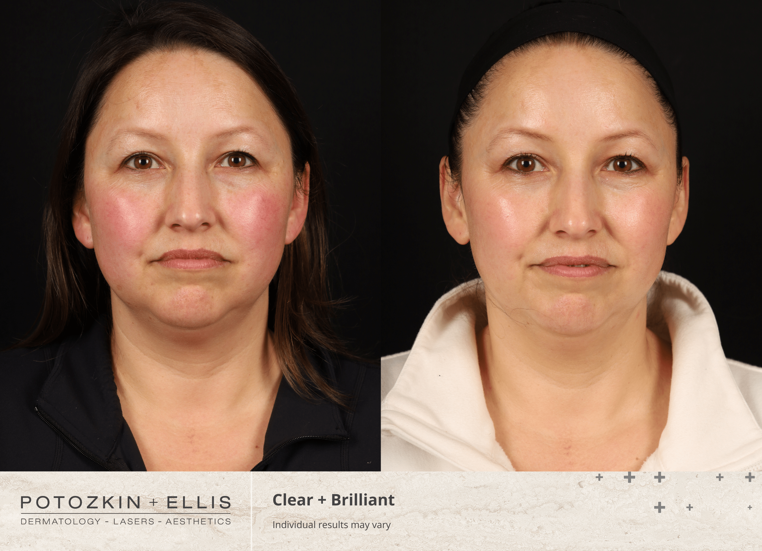 Potozkin + Ellis | Clear + Brilliant treatment