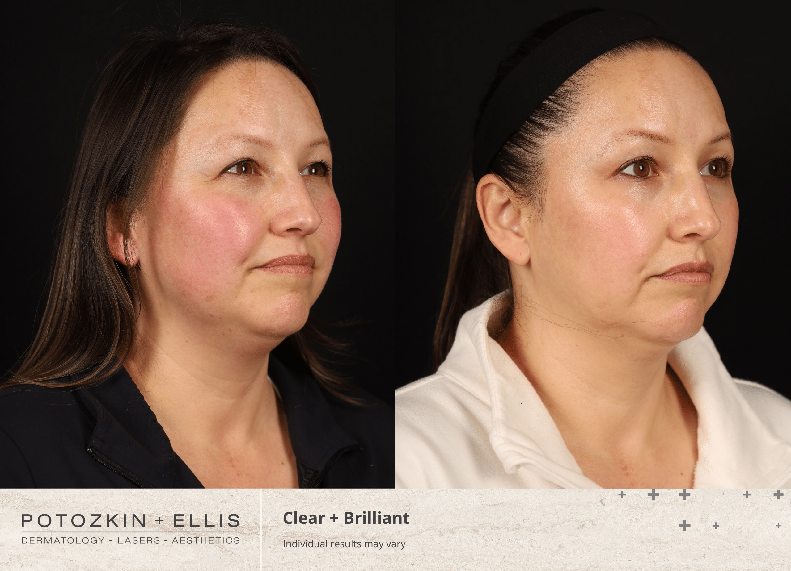 Potozkin + Ellis | Clear + Brilliant treatment