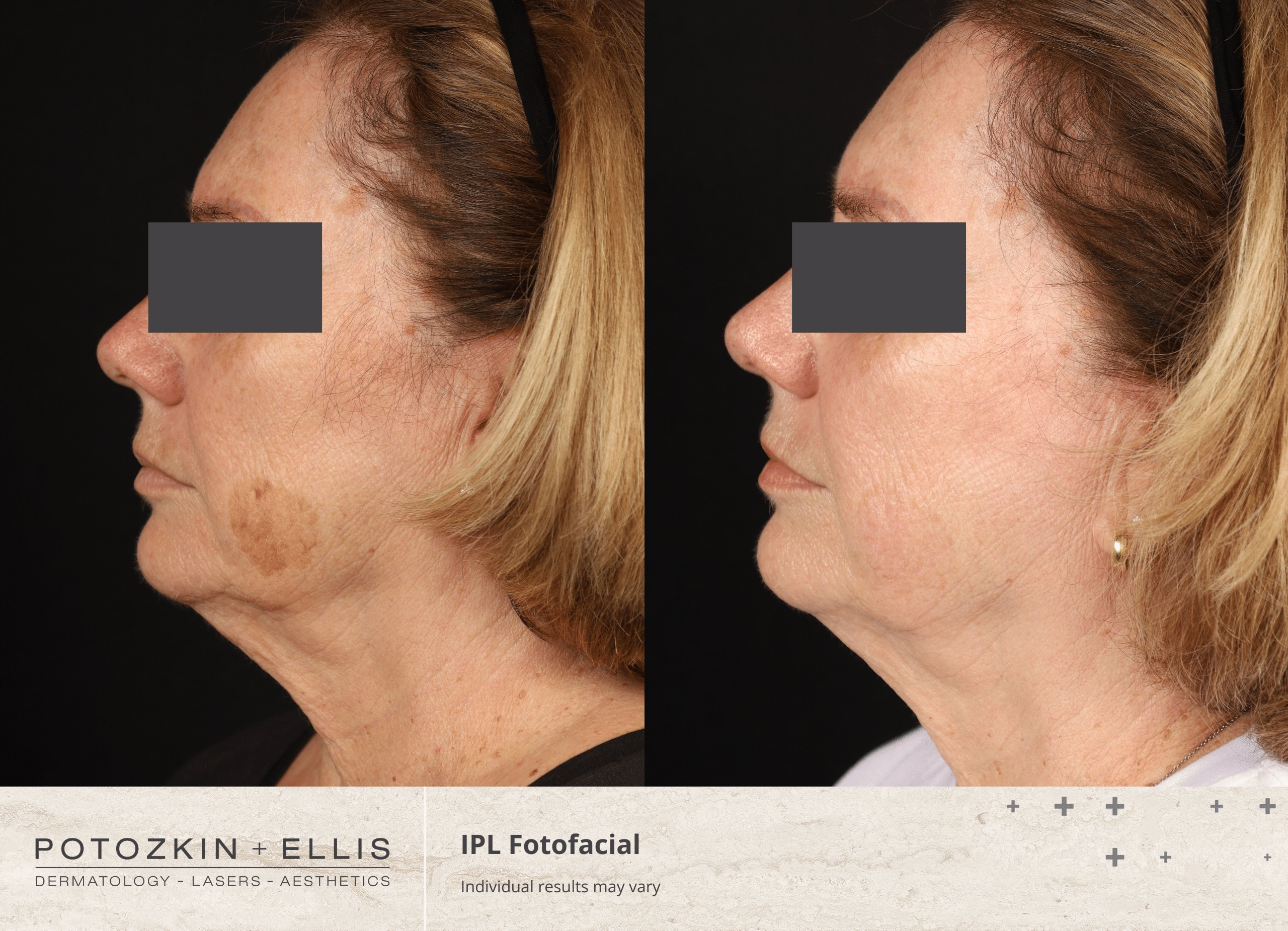 Potozkin + Ellis | IPL Photofacial treatment