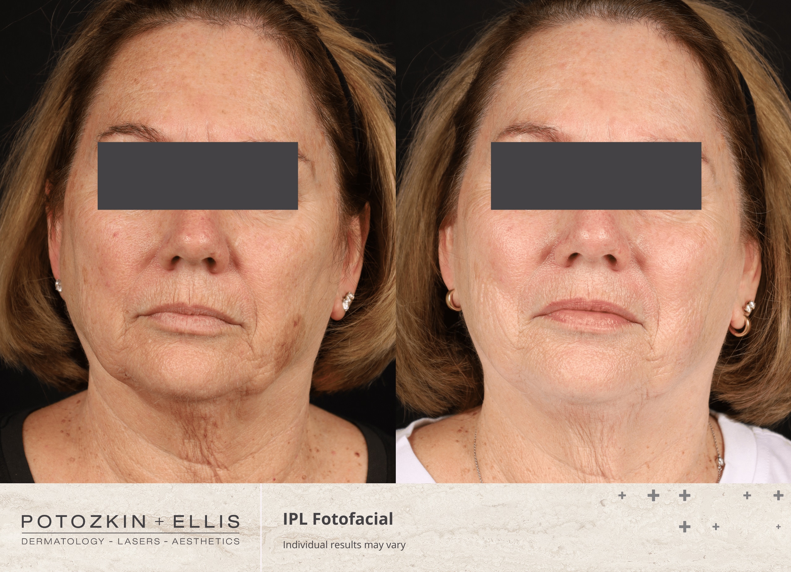 Potozkin + Ellis | IPL Photofacial treatment