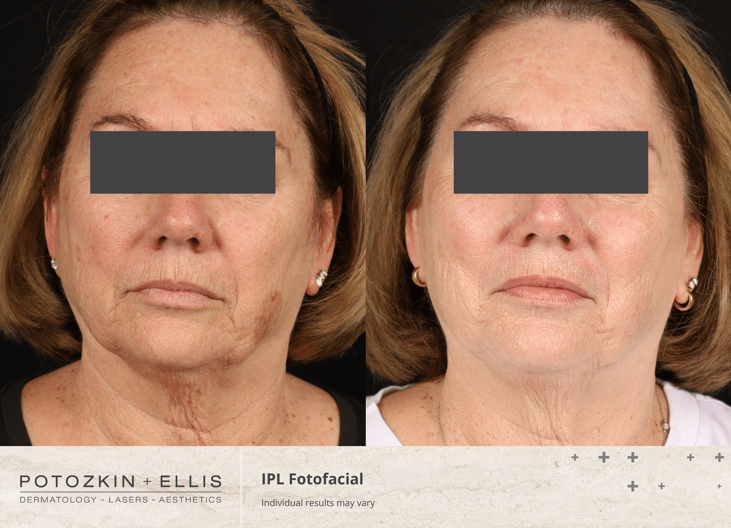 Potozkin + Ellis | IPL Photofacial treatment