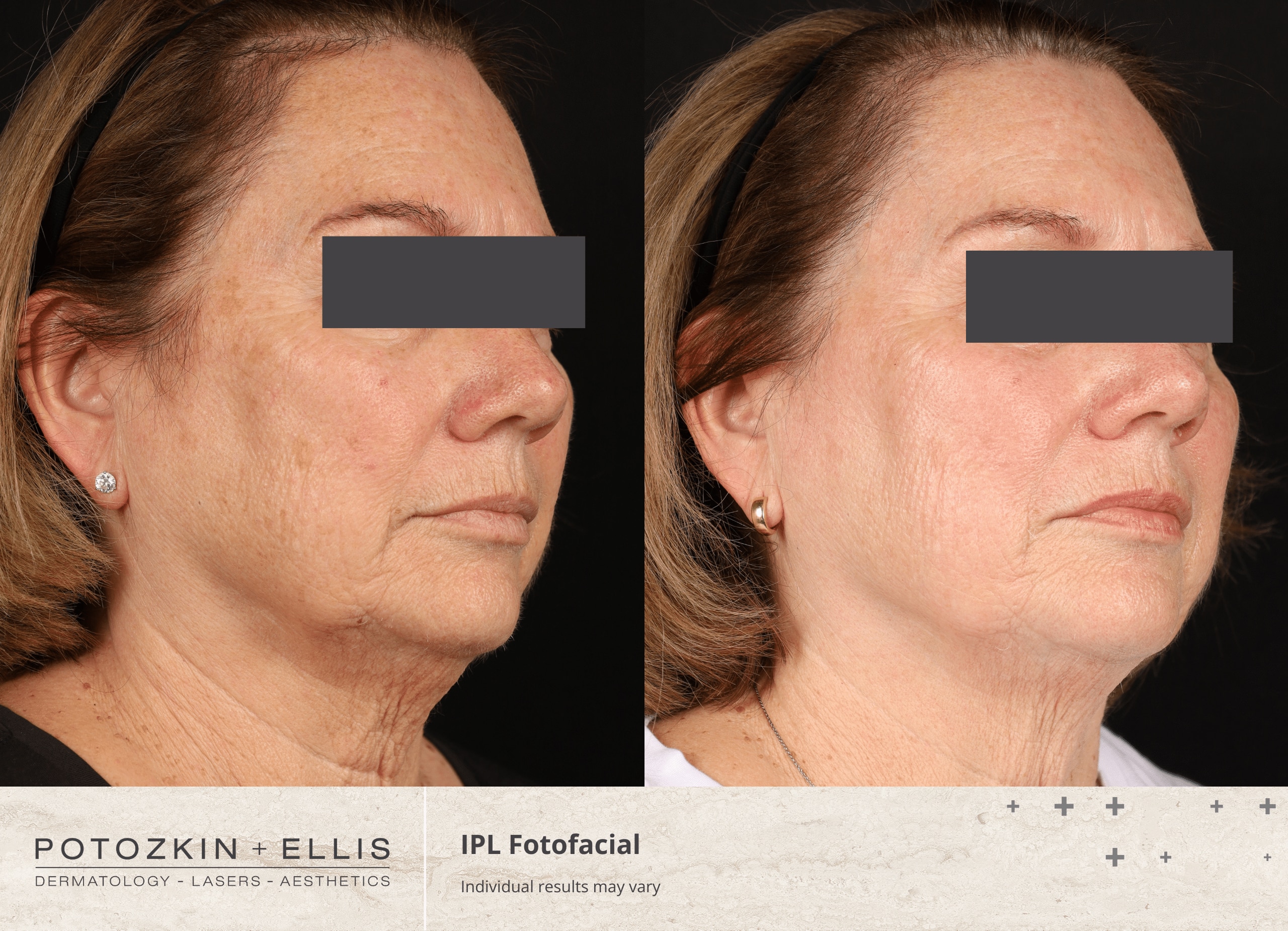Potozkin + Ellis | IPL Photofacial treatment
