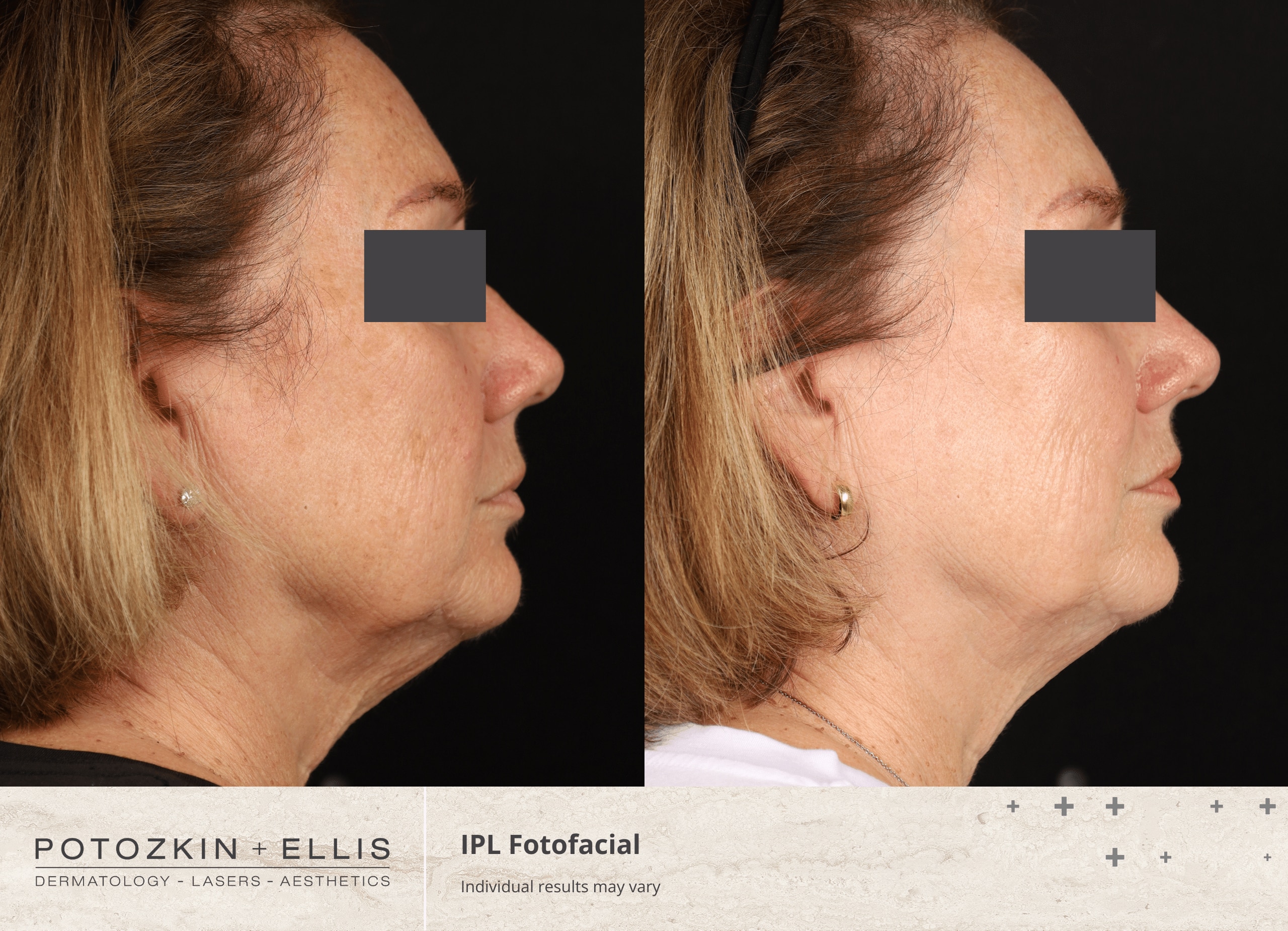 Potozkin + Ellis | IPL Photofacial treatment