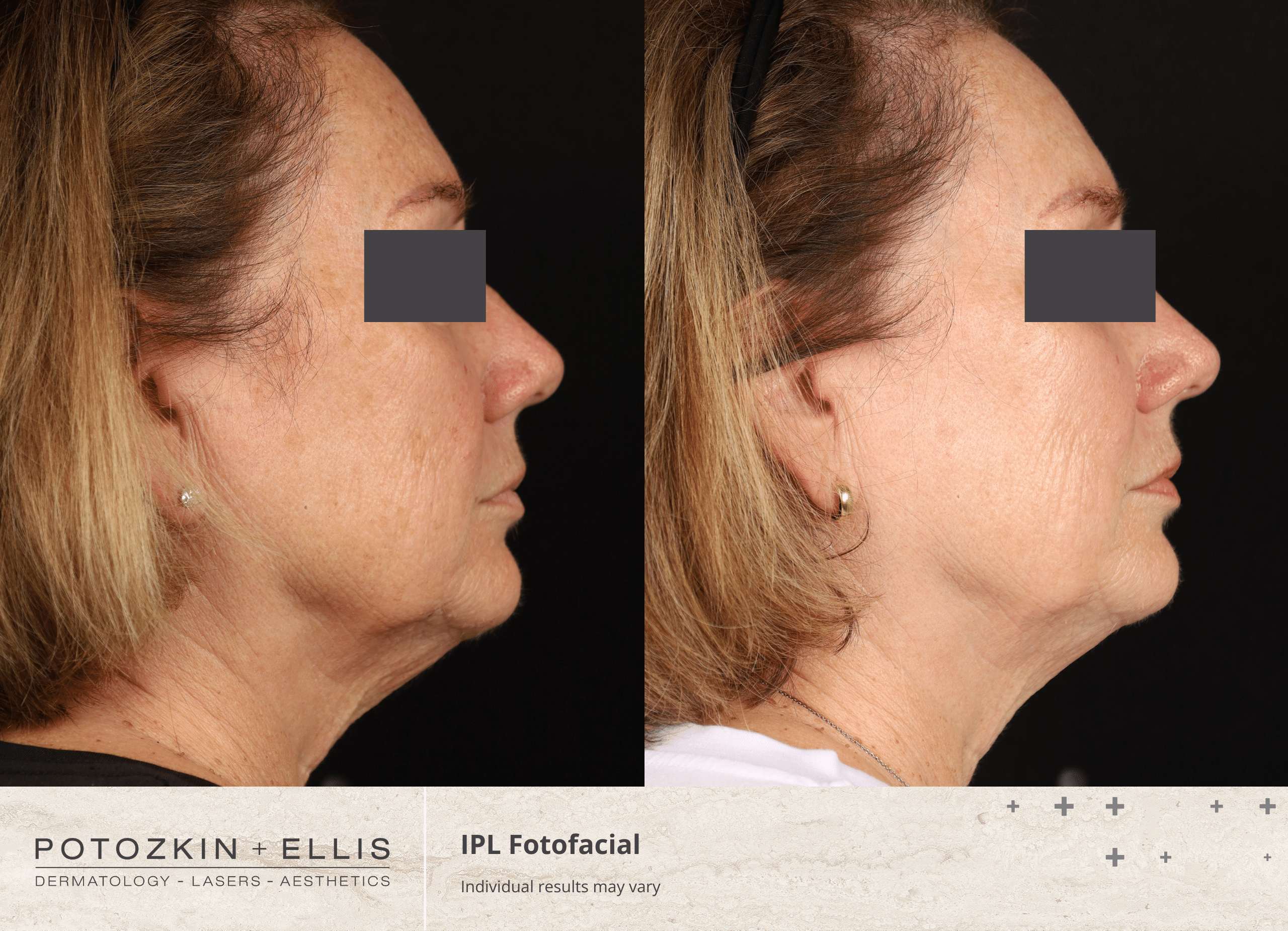 Potozkin + Ellis | IPL Photofacial treatment
