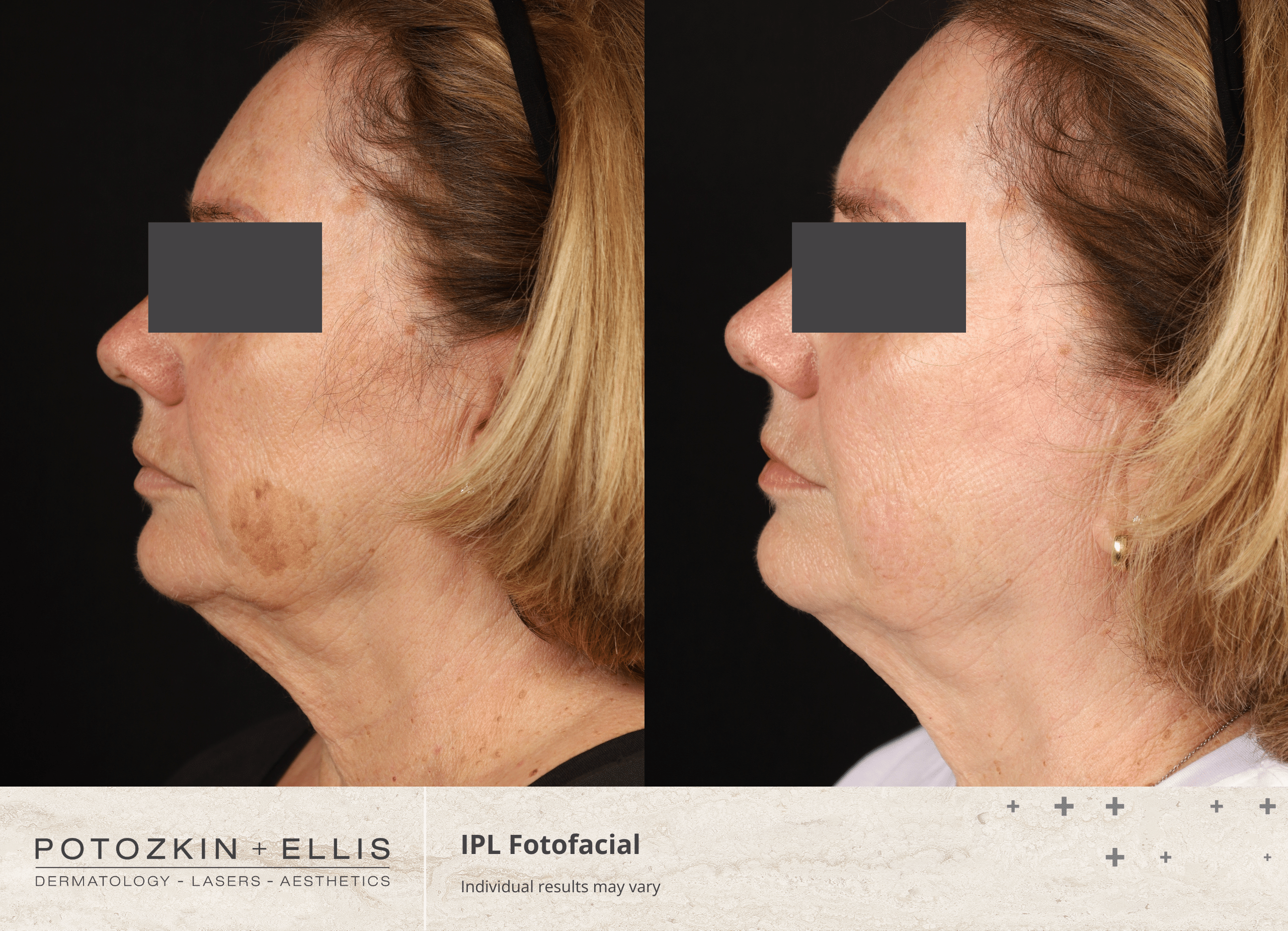 Potozkin + Ellis | IPL Photofacial treatment