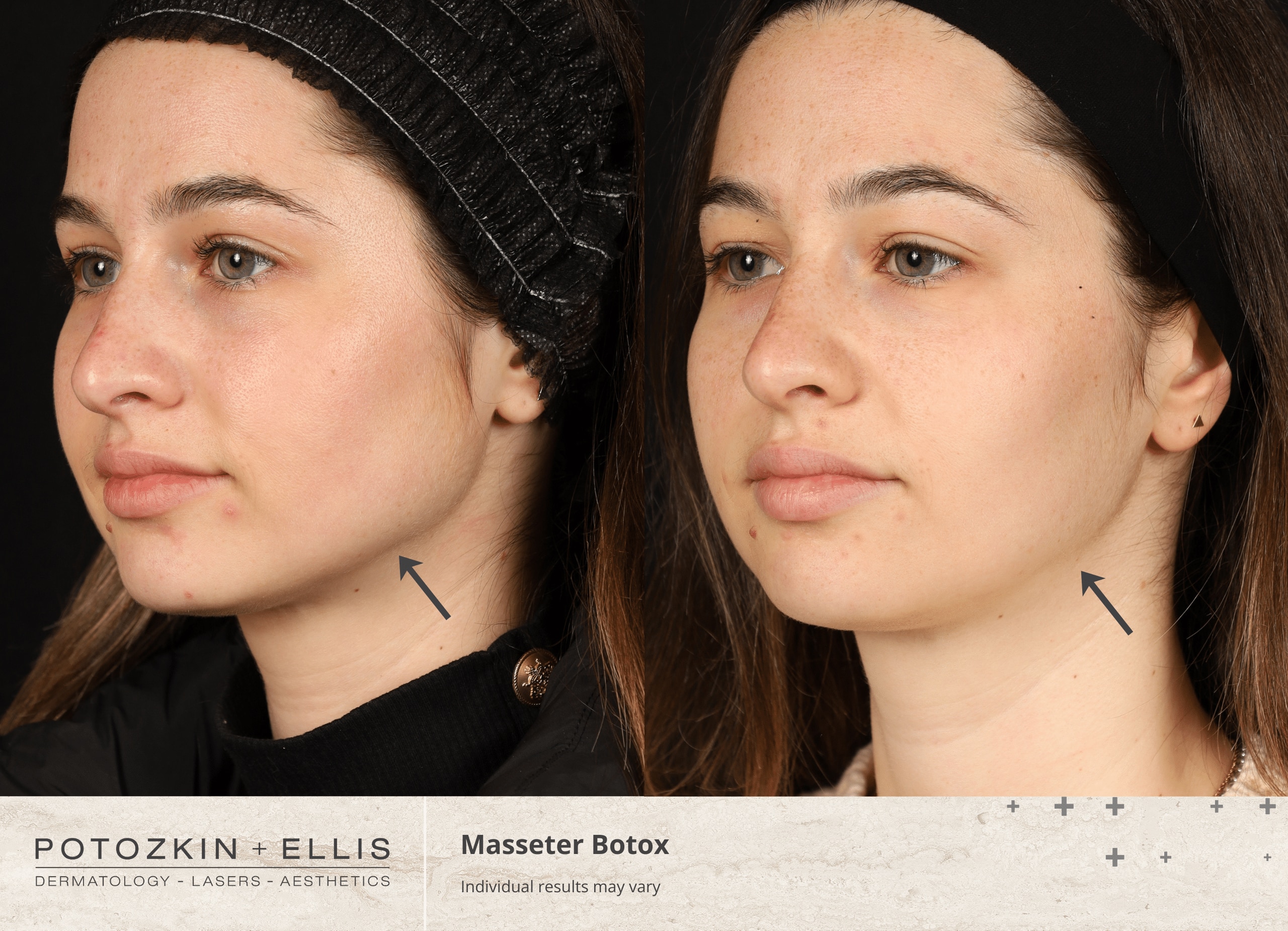 Potozkin + Ellis | Masseter Botox treatment