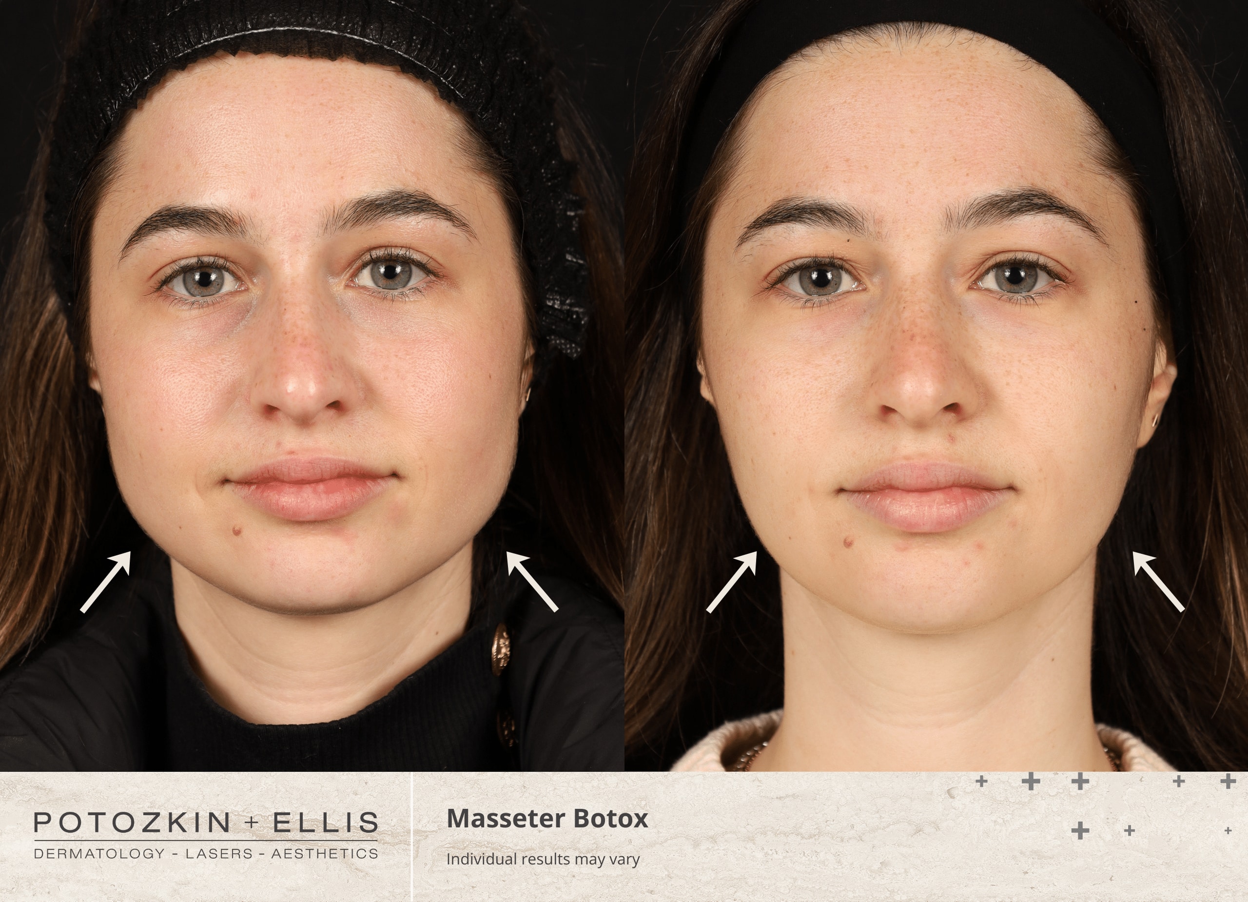Potozkin + Ellis | Masseter Botox treatment