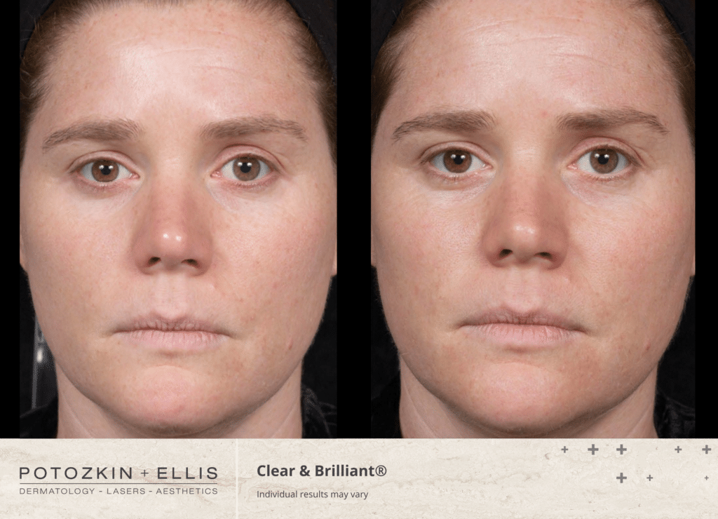 before and after results clear + brilliant laser in Danville, ca